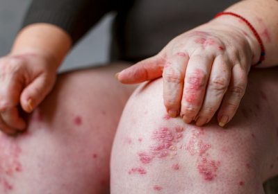 The different types of psoriasis and their unique treatments