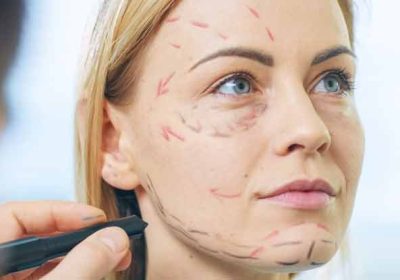 What To Expect Before Getting A Face Lifting Treatment