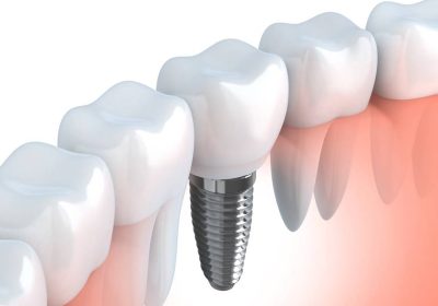 Changing Lives with All-on-4-QLD Dental Implants: A Contemporary Approach