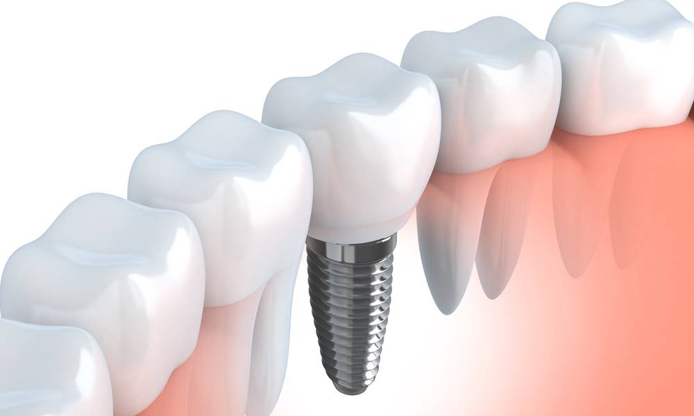 Changing Lives with All-on-4-QLD Dental Implants