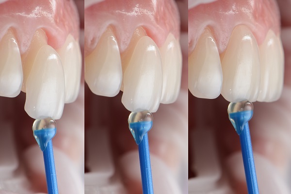 Composite veneers 