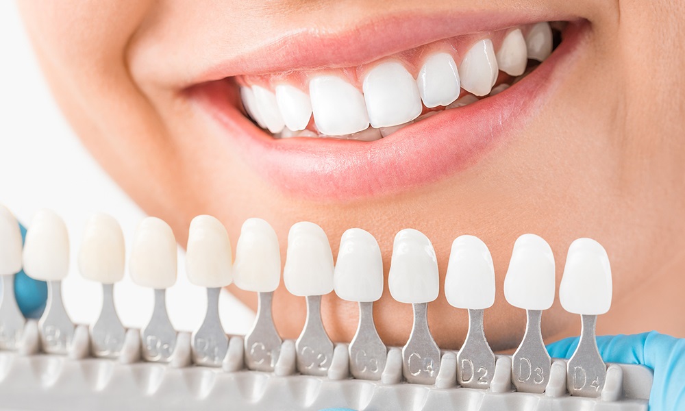 porcelain veneers