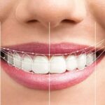 Build Your Own Smile Makeover Package