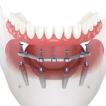 Comprehensive Guide to Caring for Implant-Supported Dentures in Toronto