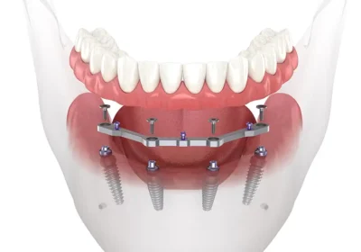 Comprehensive Guide to Caring for Implant-Supported Dentures in Toronto