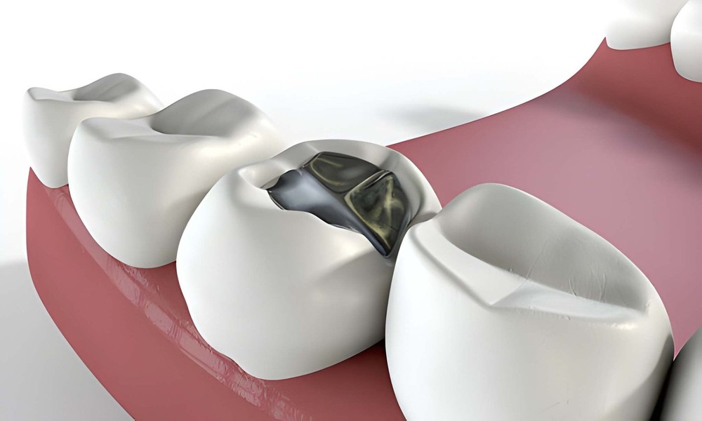 Silver Diamine Fluoride vs Traditional Fillings – Which Is Better?